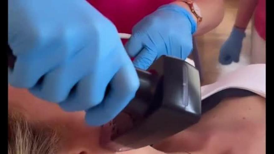 Ilary Blasi si fa un lifting (con radiofrequenza e microaghi) e pubblica il video su Instagram